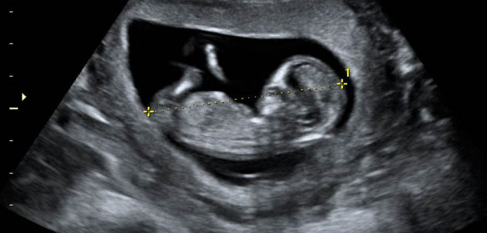 Imagen ISUOG Guías Prácticas: realización de la exploración ecográfica fetal del primer trimestre